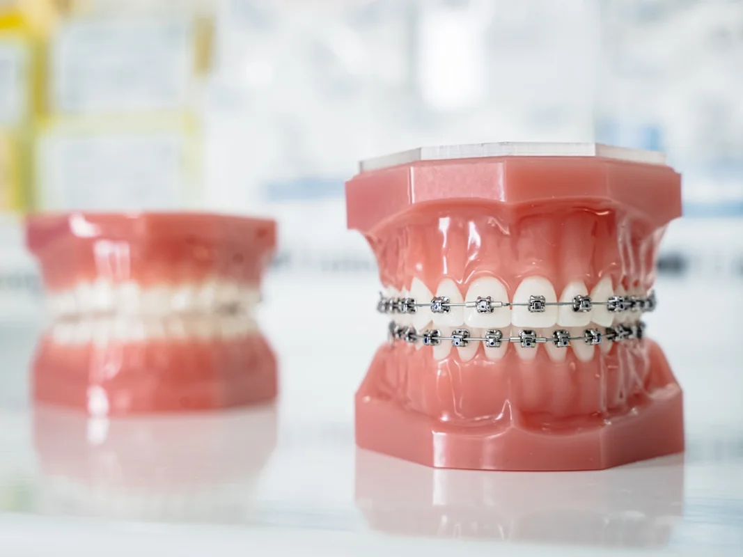A close up of a tooth with braces on it
